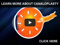 Más información sobre el procedimiento de canaloplastia para el Glaucoma