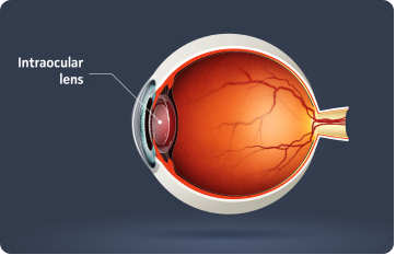 Intraocular Lens
