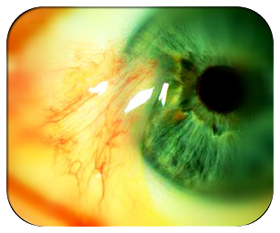 pterygium example