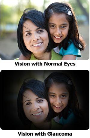 Normal Glaucoma Vision